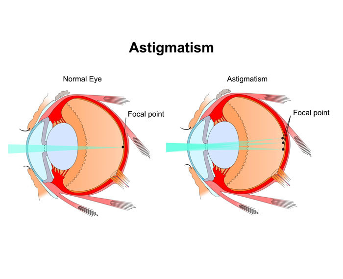 astigmatism